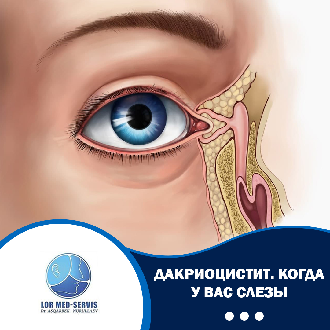 ДАКРИОЦИСТИТ https://lor-rinoplastika.com/wp-content/uploads/2021/08/ДАКРИОЦИСТИТ.jpg
