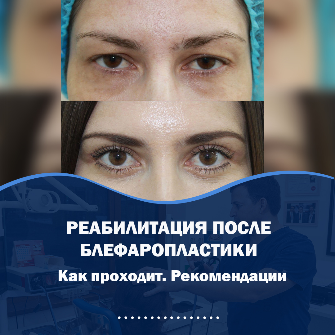 РЕАБИЛИТАЦИЯ_ПОСЛЕ_БЛЕФАРОПЛАСТИКИ2 https://lor-rinoplastika.com/wp-content/uploads/2021/08/РЕАБИЛИТАЦИЯ_ПОСЛЕ_БЛЕФАРОПЛАСТИКИ2.jpg
